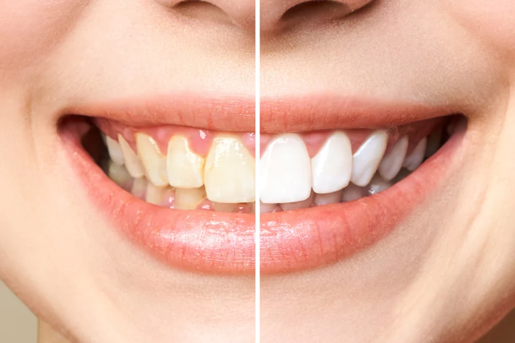 Teeth Whitening Perth Enhance Beautiful smile West Coast Dental Care