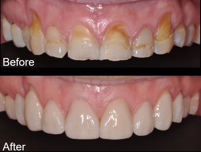 Are You Ready for a Smile Makeover? West Coast Dental Care
